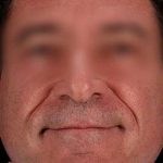 Facelift Before & After Patient #1899