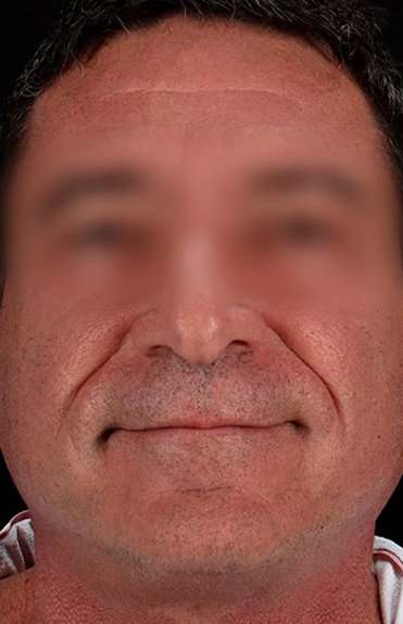 Facelift Before & After Patient #1899