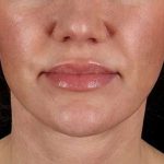 Facelift Before & After Patient #1921