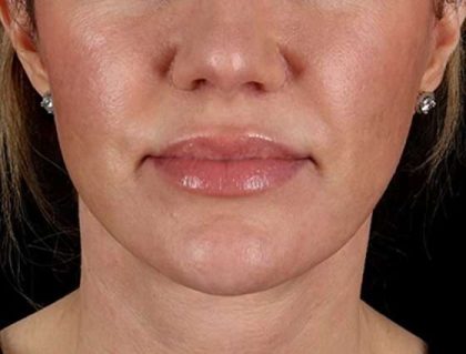 Facelift Before & After Patient #1921