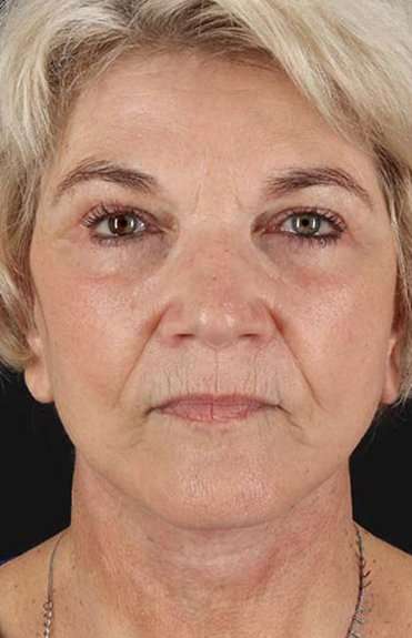 Facelift Before & After Patient #1943