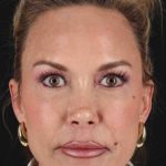 Facelift Before & After Patient #1954