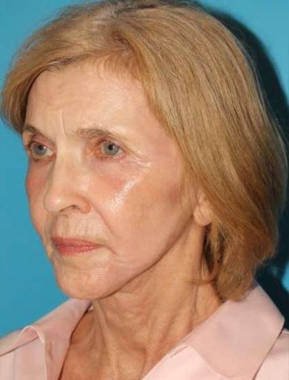 Facelift Before & After Patient #1959