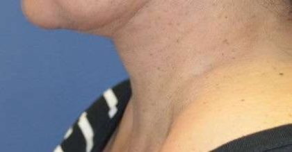 Facelift Before & After Patient #1962