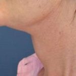 Facelift Before & After Patient #1965
