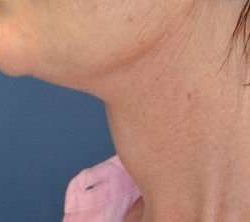 Facelift Before & After Patient #1965