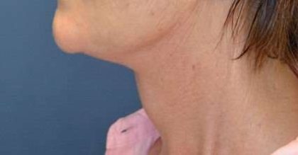 Facelift Before & After Patient #1965
