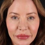 Browlift Before & After Patient #1308