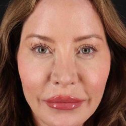 Browlift Before & After Patient #1308