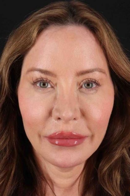Browlift Before & After Patient #1308
