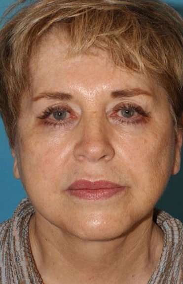 Facelift Before & After Patient #1975