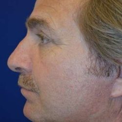 Facelift Before & After Patient #1981