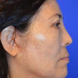 Facelift Before & After Patient #1984