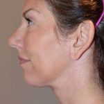 Facelift Before & After Patient #1987