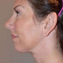 Facelift Before & After Patient #1987