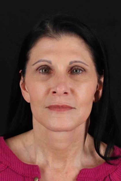 Fat Grafting To The Face Before & After Patient #2005