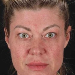 Fat Grafting To The Face Before & After Patient #2016