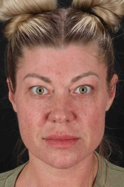 Fat Grafting To The Face Before & After Patient #2016