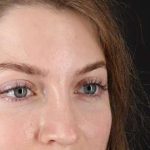 Browlift Before & After Patient #1319