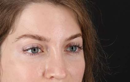 Browlift Before & After Patient #1319