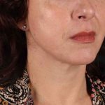 Neck Lift Before & After Patient #2472
