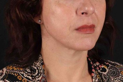 Neck Lift Before & After Patient #2472