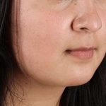 Neck Lift Before & After Patient #2549