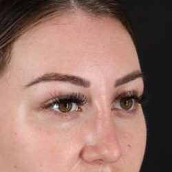 Browlift Before & After Patient #1330