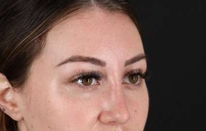 Browlift Before & After Patient #1330