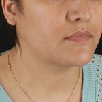 Neck Lift Before & After Patient #2560
