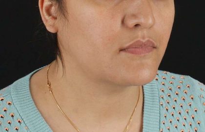 Neck Lift Before & After Patient #2560