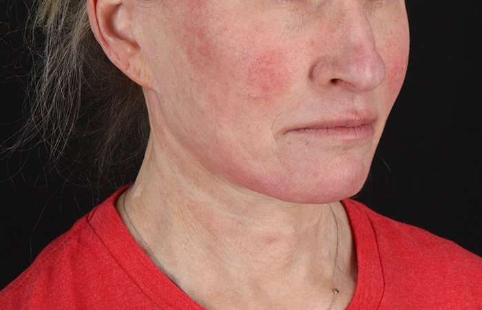 Neck Lift Before & After Patient #2571