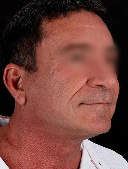 Neck Lift Before & After Patient #2604