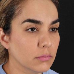 Browlift Before & After Patient #1341