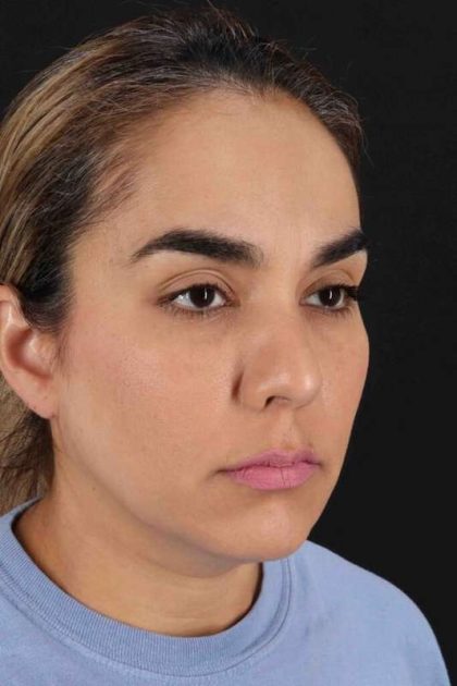 Browlift Before & After Patient #1341