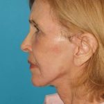 Neck Lift Before & After Patient #2664