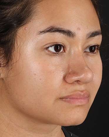 Neck Liposuction Before & After Patient #2730