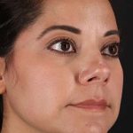 Neck Liposuction Before & After Patient #2752