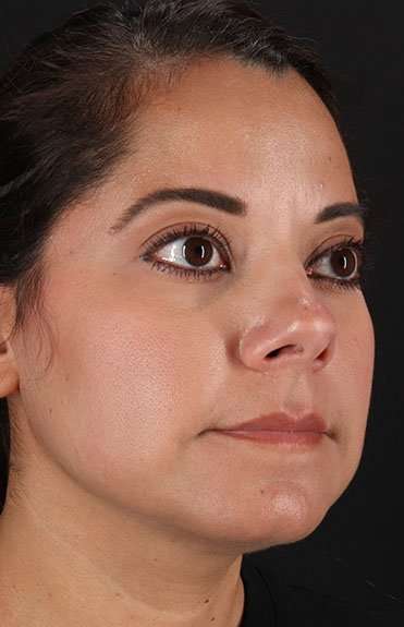 Neck Liposuction Before & After Patient #2752