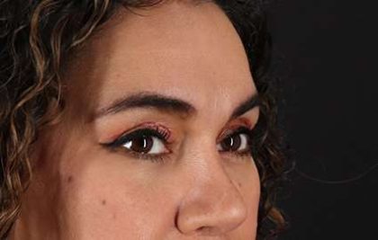 Browlift Before & After Patient #1352