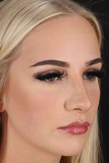Rhinoplasty Before & After Patient #2807