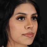 Rhinoplasty Before & After Patient #2818