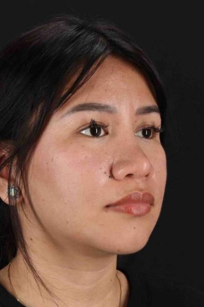 Rhinoplasty Before & After Patient #2829