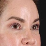 Rhinoplasty Before & After Patient #2840