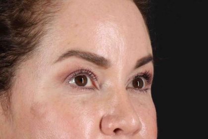 Rhinoplasty Before & After Patient #2840