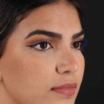Rhinoplasty Before & After Patient #2862