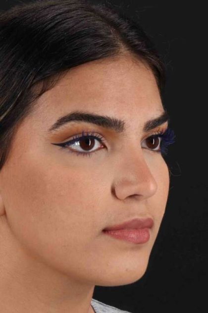 Rhinoplasty Before & After Patient #2862