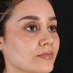 Rhinoplasty Before & After Patient #2873
