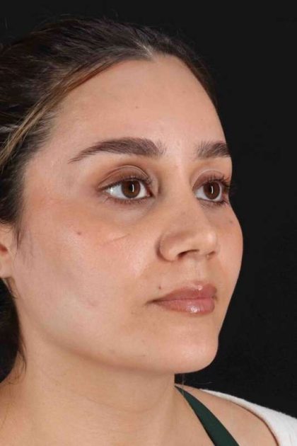 Rhinoplasty Before & After Patient #2873