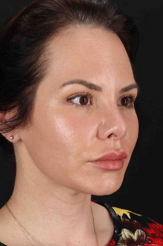 Rhinoplasty Before & After Patient #2884